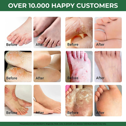 Powerful topical serum for stubborn foot fungus